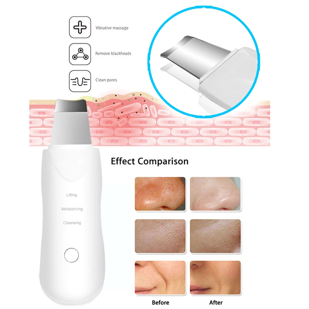 Ultrasonic Skin Scrubber — Blackhead & Pore Cleaner